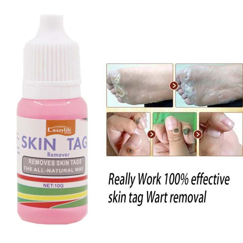 Skin tag 8